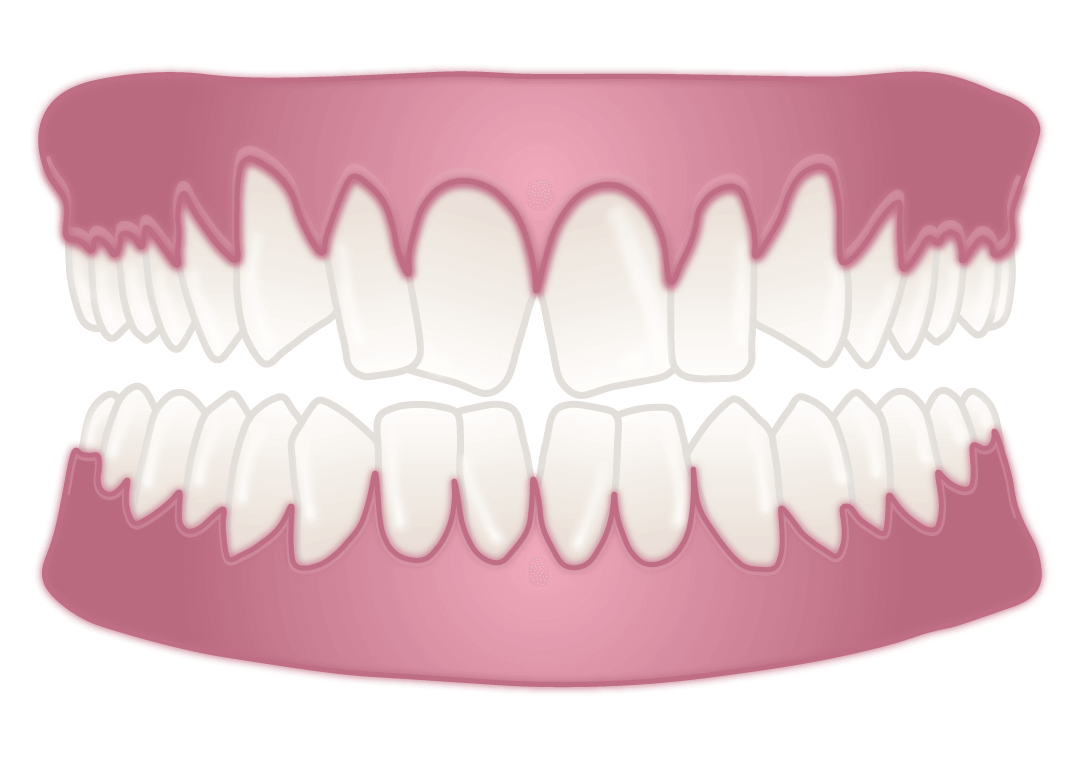 crooked teeth