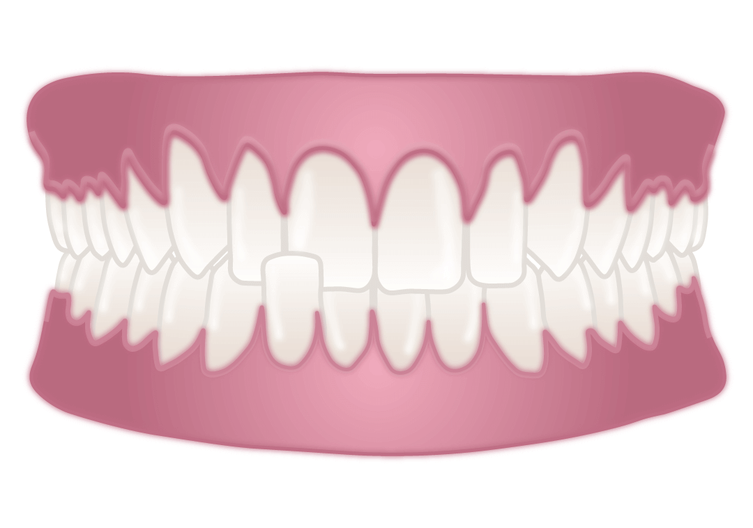 crossbite in teeth