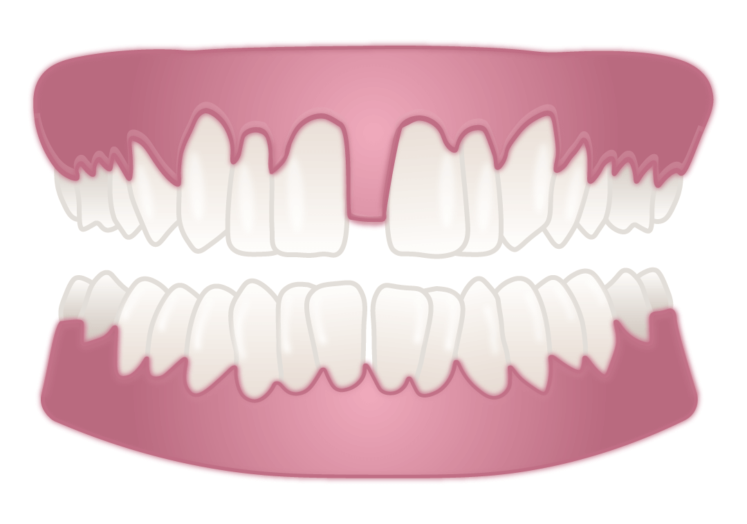 gap in teeth